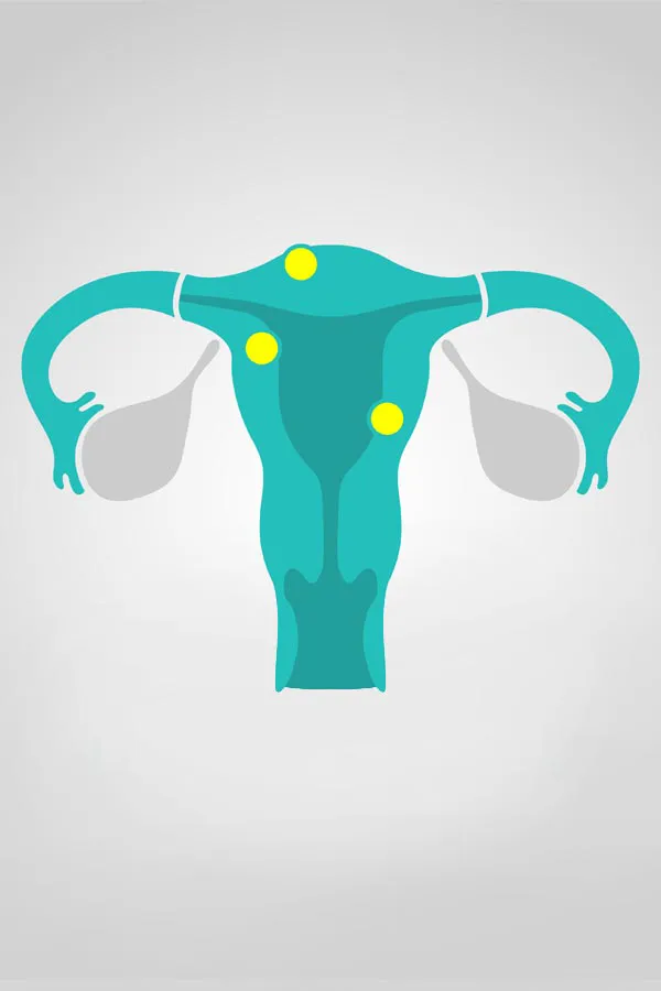 Illustration of a uterus with yellow dots indicating fibroids. Get treatment for fibroids from Deborah Wilson, M.D. & Associates in Scottsdale.